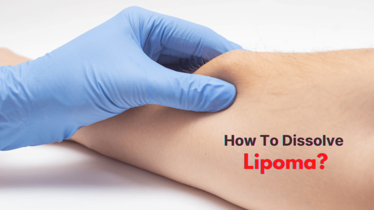 Lipoma Treatment Without Surgery Dr Rahul Singh 
